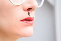 Thảo dược phòng và điều trị chảy máu mũi