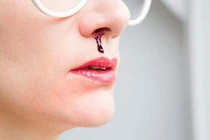 Thảo dược phòng và điều trị chảy máu mũi