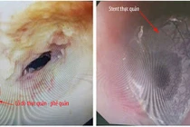 Bệnh nhân suýt chết vì mắc phải căn bệnh hiếm gặp