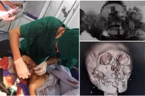 Hội chẩn từ xa cứu trẻ 9 tuổi dập nát vùng mặt do pháo tự chế