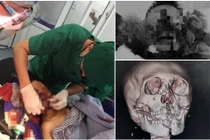 Hội chẩn từ xa cứu trẻ 9 tuổi dập nát vùng mặt do pháo tự chế