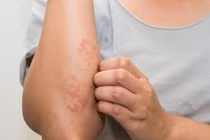 Viêm da cơ địa, điều trị thuốc Tây hay thuốc Nam?