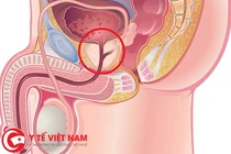 Biến chứng thường gặp của u xơ tiền liệt tuyến