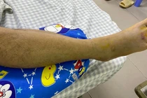 Cứu bệnh nhân rắn cắn bằng huyết thanh kháng nọc đặc hiệu ngay tại tuyến tỉnh