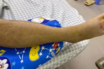 Cứu bệnh nhân rắn cắn bằng huyết thanh kháng nọc đặc hiệu ngay tại tuyến tỉnh