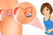 U nang buồng trứng thường gặp ở độ tuổi nào? Làm sao để phòng bệnh?