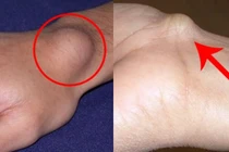 U sụn mọc nhiều ở tay, chân