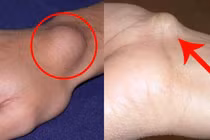 U sụn mọc nhiều ở tay, chân