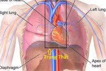  U trung thất ở nhiều vị trí khác nhau
