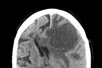 Điều trị ung thư phổi di căn não