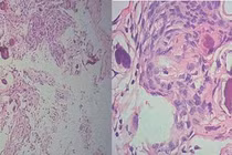 Suýt liệt vì u màng tủy