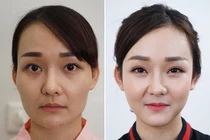 Tạo hình nâng gò má thấp