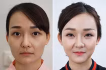 Tạo hình nâng gò má thấp