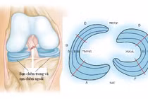 Rách sừng sau sụn chêm