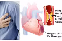 Đừng coi thường chứng đau thắt ngực ổn định