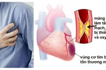 Đừng coi thường chứng đau thắt ngực ổn định