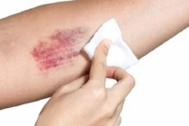 Đông y có điều trị được bệnh tăng tiểu cầu tiên phát?