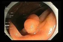 Thường xuyên đại tiện ra máu