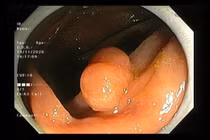 Thường xuyên đại tiện ra máu