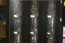 Không chủ quan với đau lưng