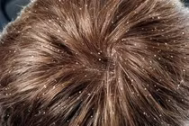 Gầu nhiều vì mũ bảo hiểm bẩn