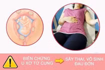 Cẩn trọng với những biến chứng nguy hiểm của bệnh u xơ tử cung