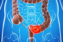Bệnh trầm trọng vì ngại đi kiểm tra