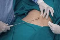 Cô gái 24 tuổi ở TPHCM tử vong sau thủ thuật làm đẹp lưng tại spa