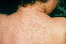 Lầm tưởng “chết người” giữa bệnh rubella, sởi và quai bị