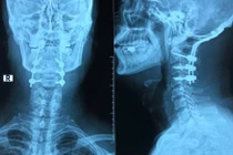 Gãy đốt sống cổ do nhảy ở bể bơi