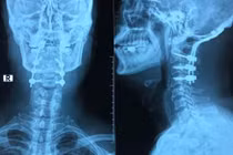 Gãy đốt sống cổ do nhảy ở bể bơi