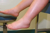 Những trường hợp phù chân phải cấp cứu