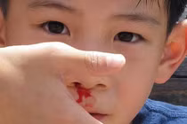 Xử lý khi bị chảy máu cam