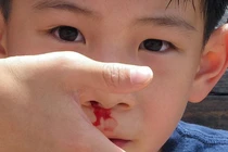 Xử lý khi bị chảy máu cam