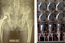 Lưu ý khi lựa chọn loại khớp để tránh thay lại khớp háng 