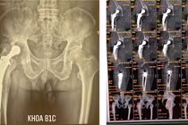 Lưu ý khi lựa chọn loại khớp để tránh thay lại khớp háng 