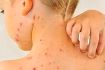 Người bị thủy đậu có được ăn sữa chua không?