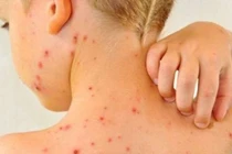 Người bị thủy đậu có được ăn sữa chua không?