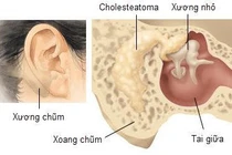 Viêm xương chũm cấp tính do viêm tai giữa