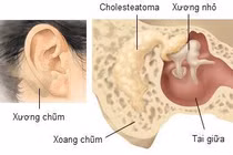 Viêm xương chũm cấp tính do viêm tai giữa