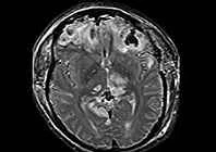Hiểu được hậu quả của chấn thương đầu đối với các bệnh thần kinh