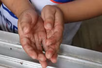 Đã có 6 trường hợp tử vong do bệnh tay chân miệng