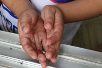 Đã có 6 trường hợp tử vong do bệnh tay chân miệng