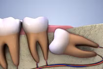 Chảy máu kéo dài do đá lưỡi sau nhổ răng khôn