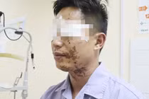 Nổ bình ga khi ăn lẩu người đàn ông bỏng vùng mặt
