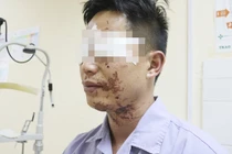 Nổ bình ga khi ăn lẩu người đàn ông bỏng vùng mặt