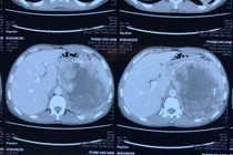 Kỹ thuật cao cứu sống người bệnh có khối u thượng thận khổng lồ