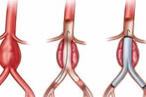 Các yếu tố gây bệnh bóc tách động mạch chủ