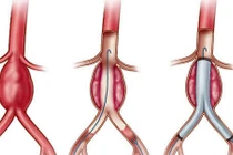 Các yếu tố gây bệnh bóc tách động mạch chủ