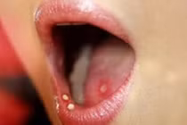 Điều trị nhiệt miệng